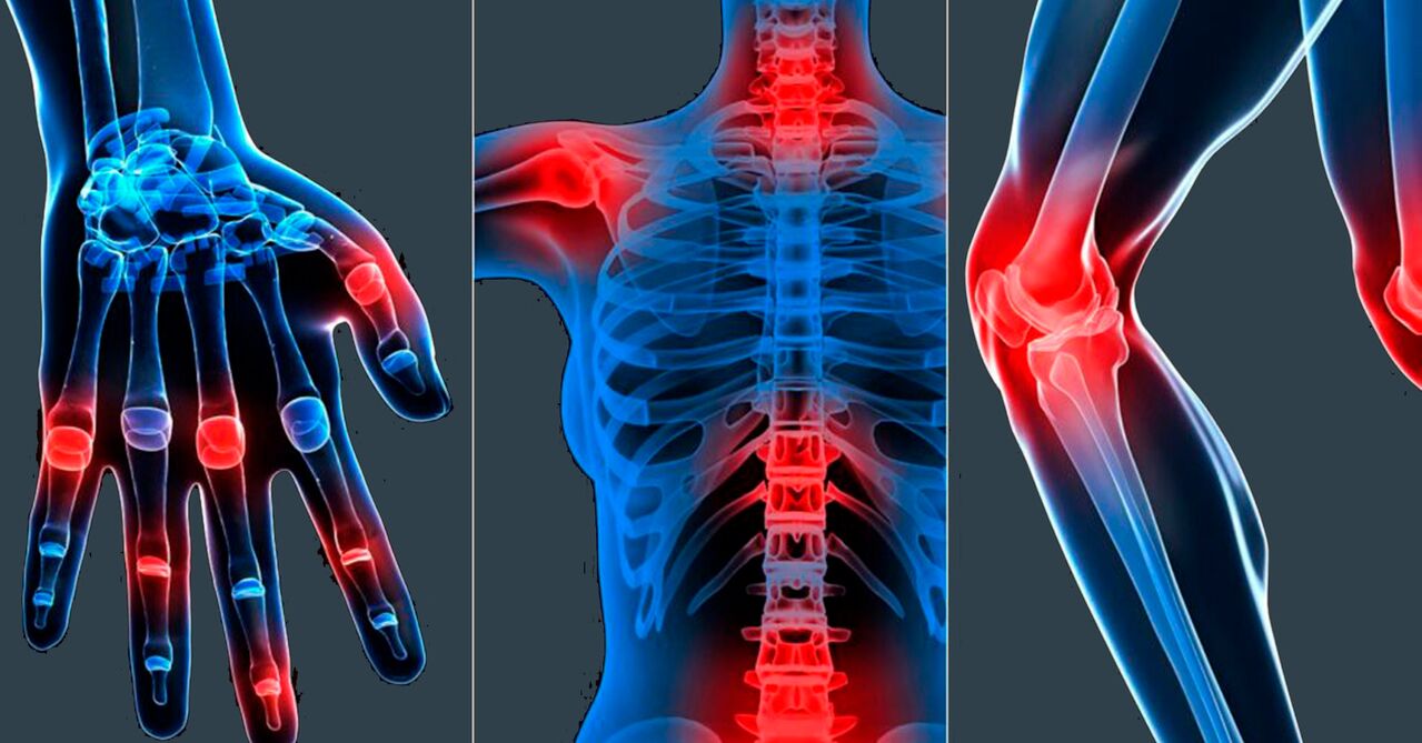 Indicaties voor gebruik van Boswellia-extract in capsules
