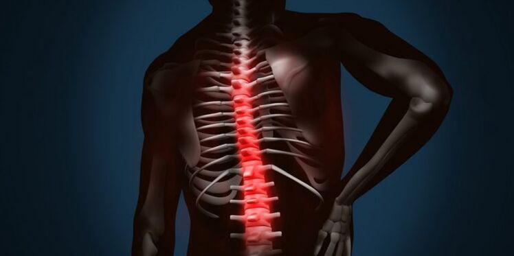 spinale laesies als gevolg van osteochondrose